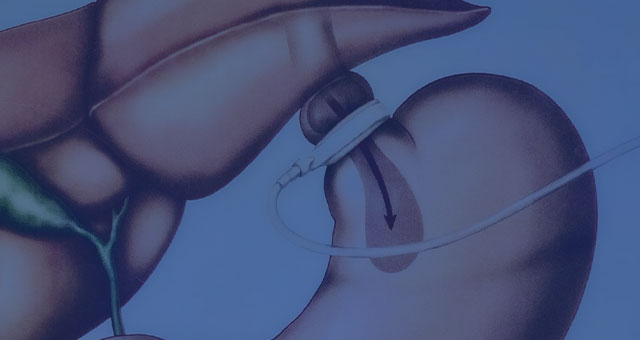 Adjustable Gastric Band - Bariatric Surgery