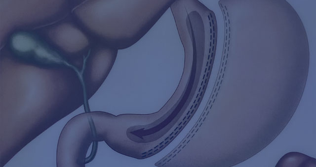 Sleeve Gastrectomy - Bariatric Surgery