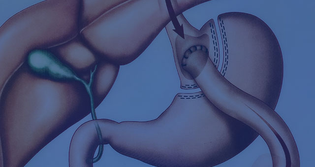 Gastric Bypass - Bariatric Surgery